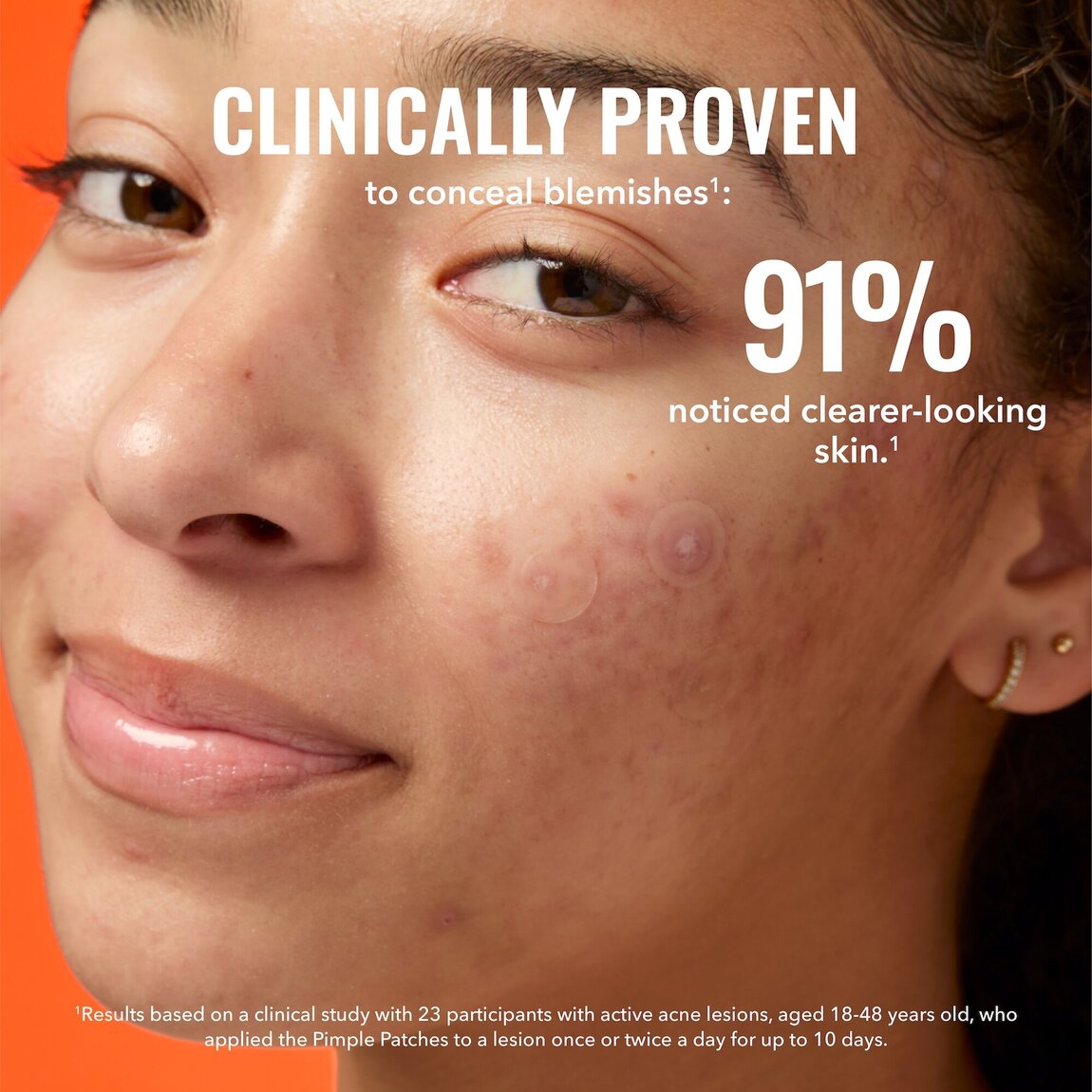 pimple-patches-g3 zb_p.jpg