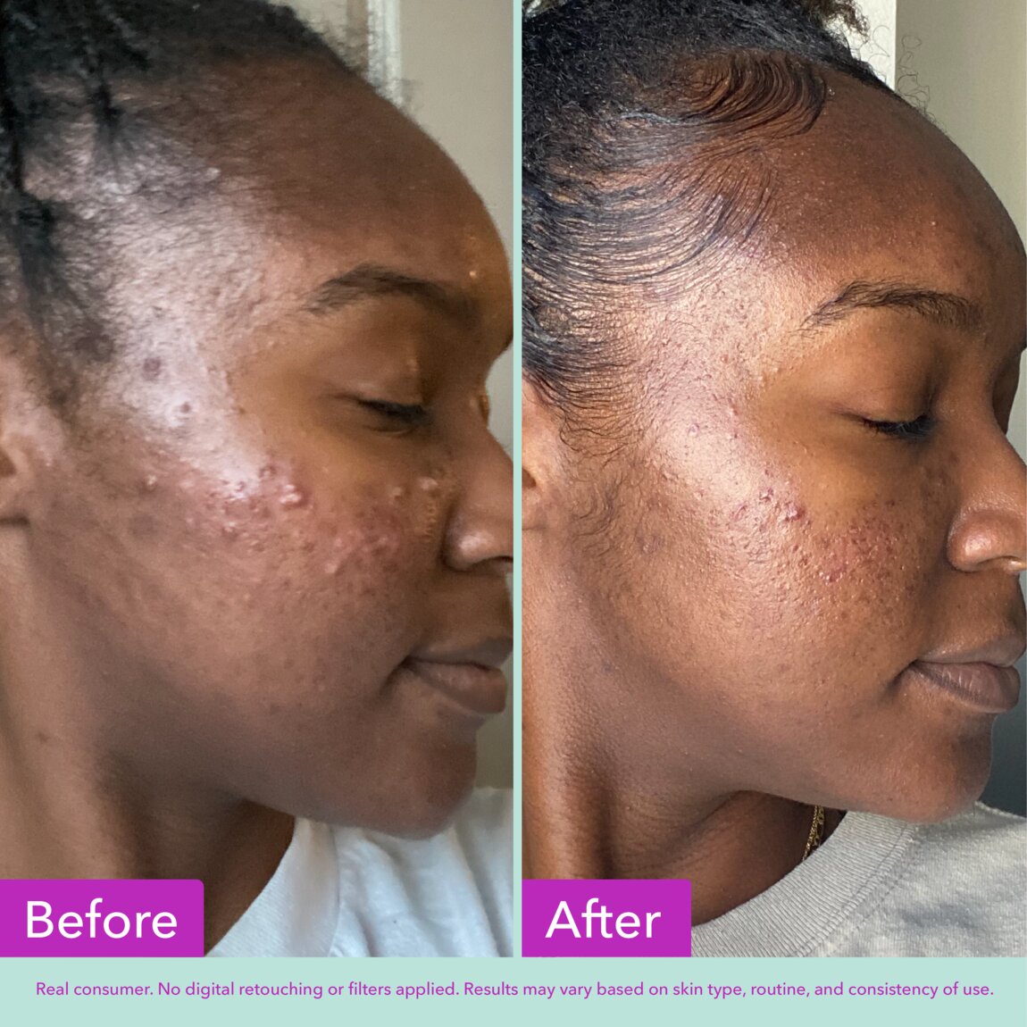 acne-foaming-cleanser-l2 zb_p.jpg